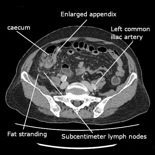Tomografía computada de abdomen mostrando apendicitis aguda: apéndice engrosado con inflamación de la grasa periapendicular.