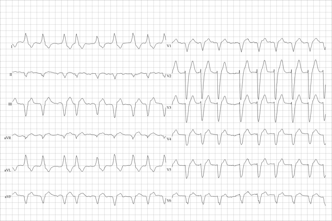 ECG de 12 derivaciones con fibrilación auricular conducida con bloqueo de rama izquierda
