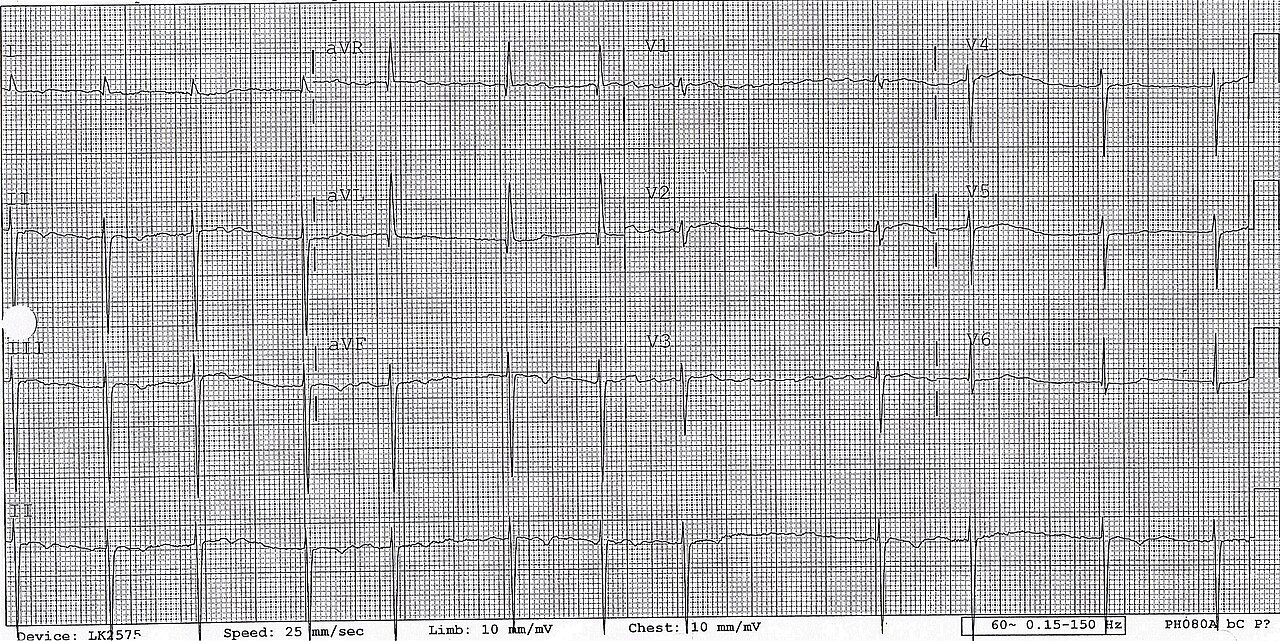 ECG de 12 derivaciones con fibrilación auricular de respuesta ventricular controlada