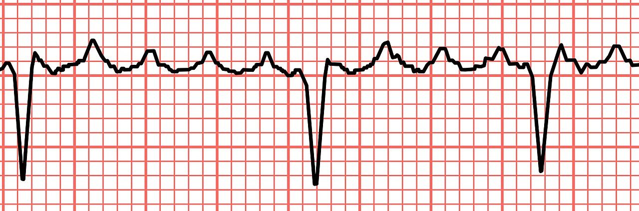 Primer plano de una tira de ritmo con ondas de aleteo auricular en dientes de sierra