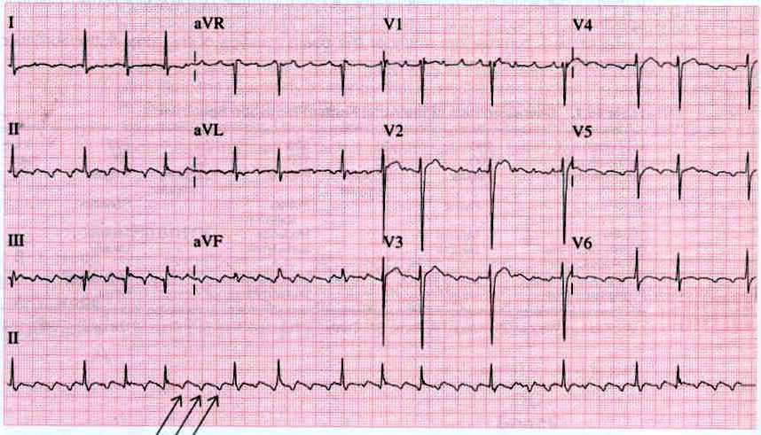 ECG de 12 derivaciones con aleteo auricular y las ondas F señaladas con flechas en la tira de ritmo