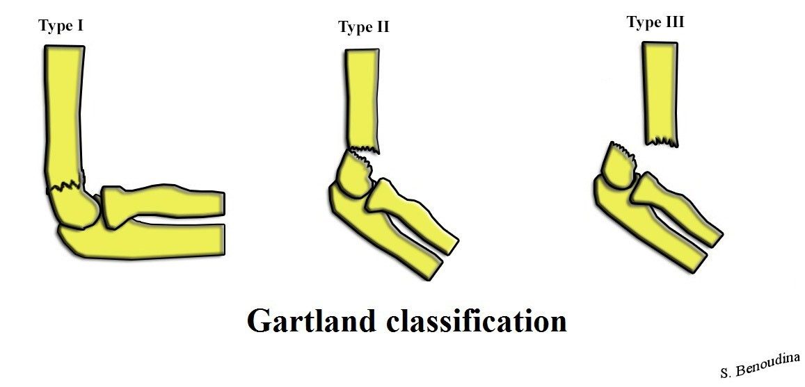 Dibujos de un codo infantil de perfil con fracturas supracondíleas tipo I, II y III.
