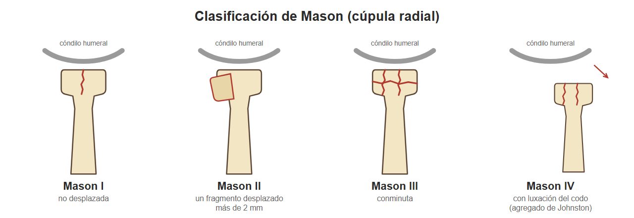 Esquemas de la cúpula radial con fracturas Mason I a IV.
