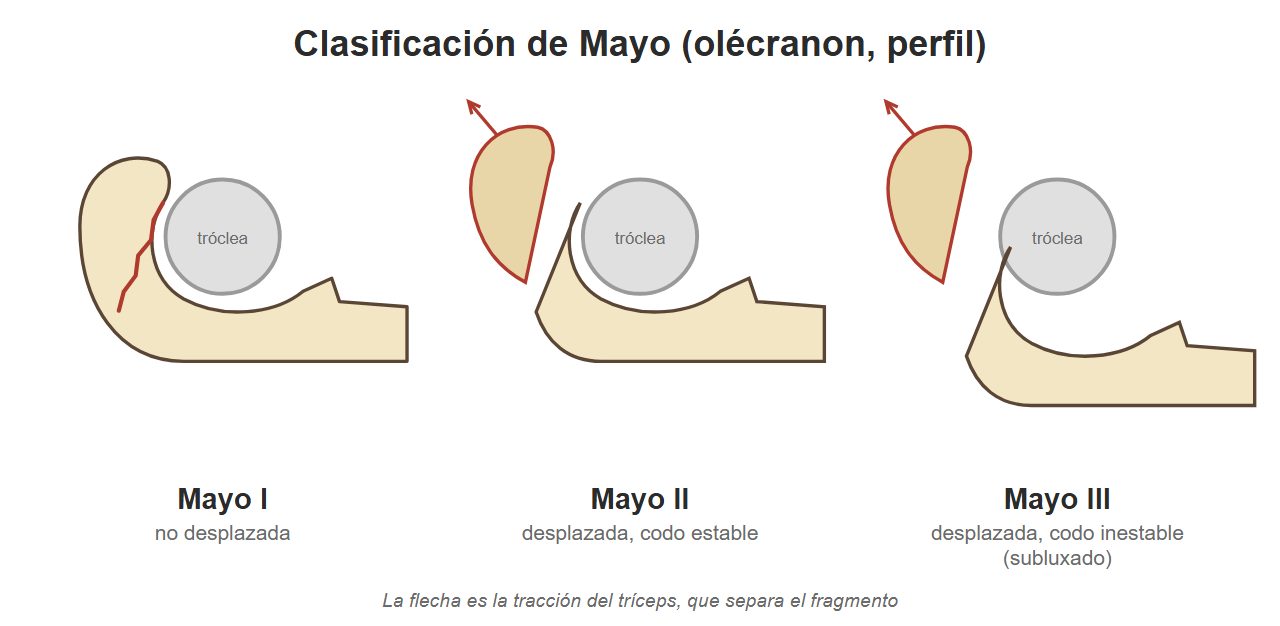 Esquemas del cúbito proximal de perfil con fracturas del olécranon Mayo I a III.