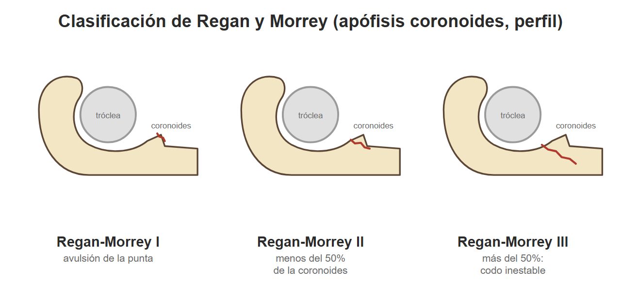 Esquemas del cúbito proximal con fracturas de la coronoides de tamaño creciente.