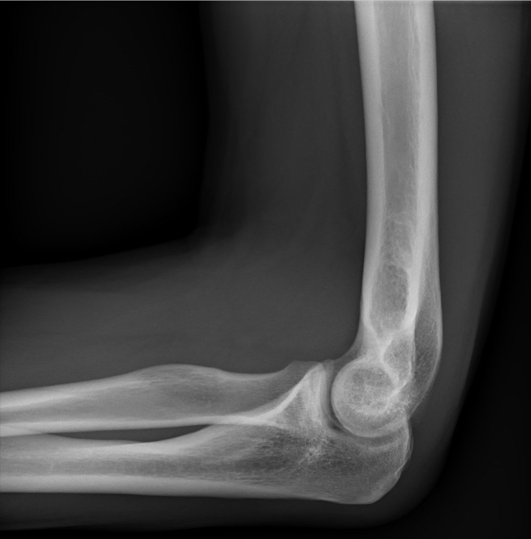 Radiografía de perfil de un codo normal a 90 grados de flexión.