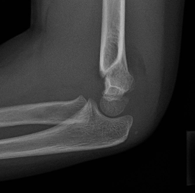 Radiografía de perfil del codo de un niño con fractura supracondílea de húmero parcialmente desplazada.