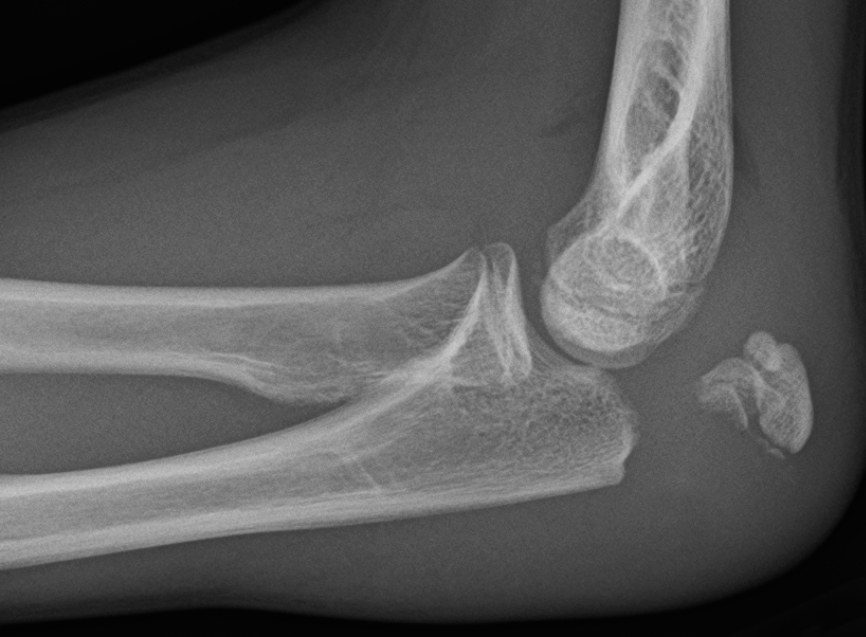 Radiografía de perfil del codo con fractura transversa del olécranon y separación de los fragmentos.