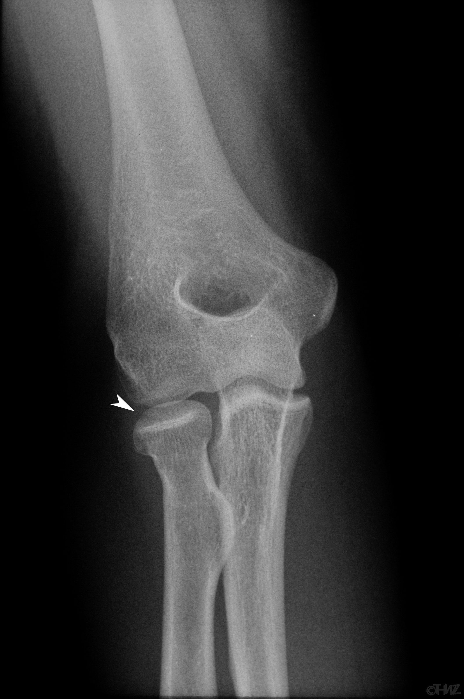 Radiografía de frente del codo con una fractura no desplazada de la cabeza del radio señalada con una punta de flecha.
