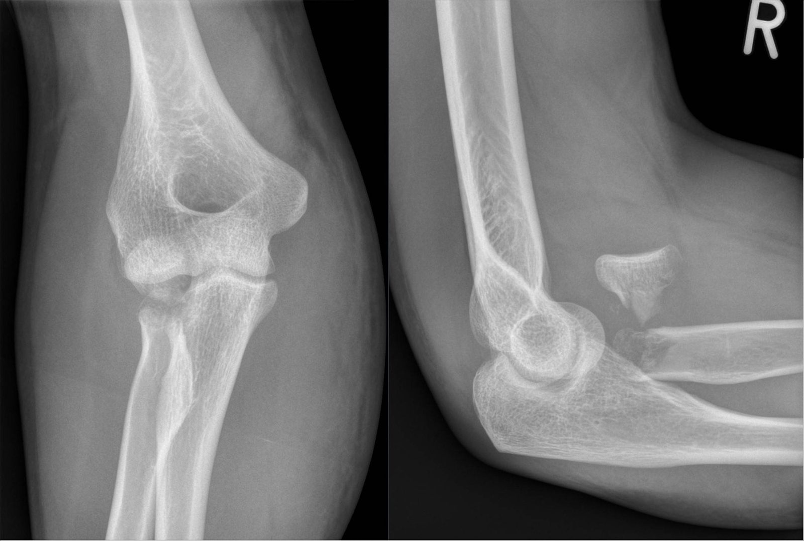 Radiografías de frente y perfil del codo con fractura conminuta y desplazada de la cabeza del radio.