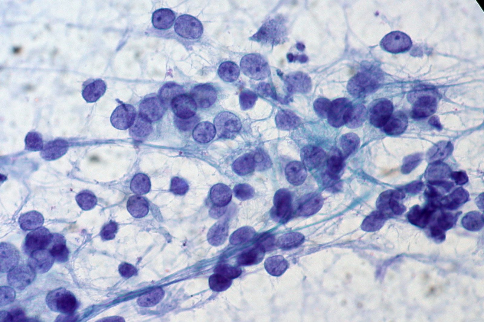 Citología por punción con aguja fina de carcinoma papilar de tiroides, mostrando núcleos con hendiduras y aspecto en 'vidrio esmerilado'.